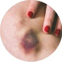 Bruises and hematomas