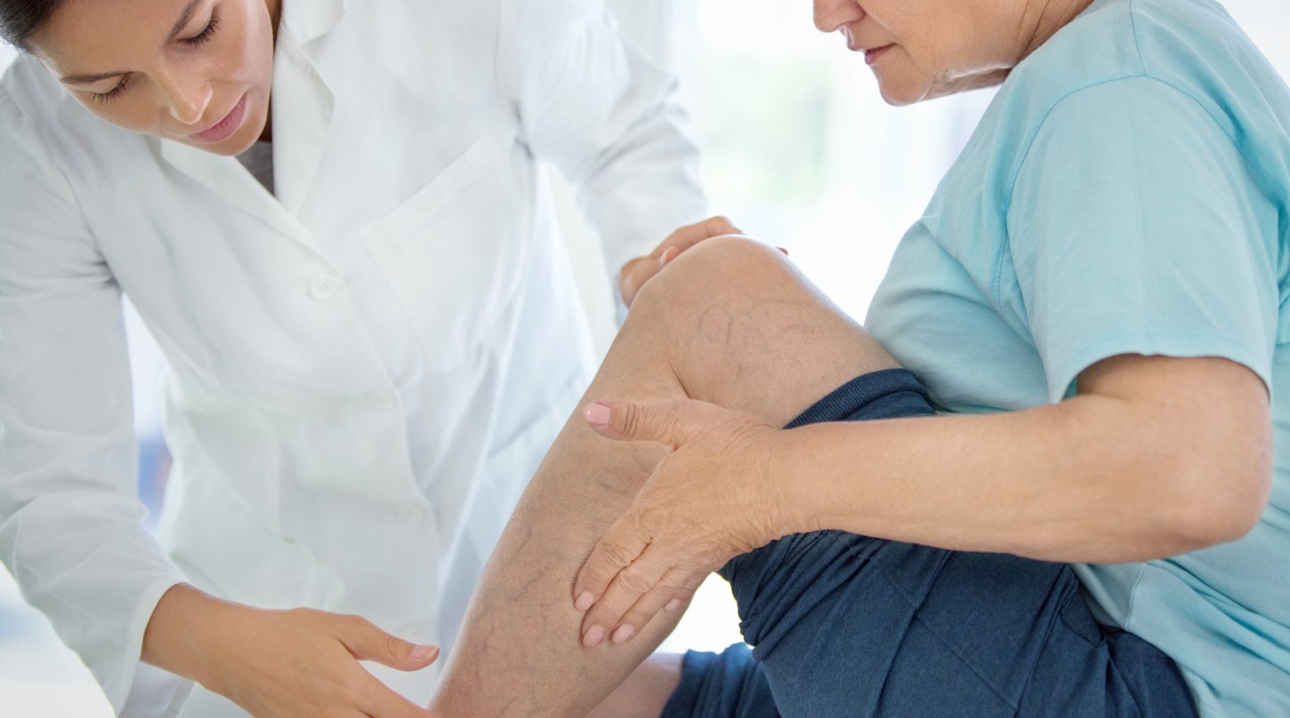 Varicose veins